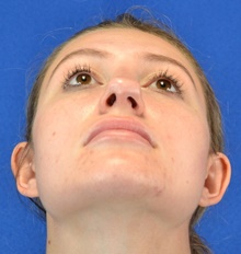 Rhinoplasty Before Photo by Alexander Slocum, MD, PhD; Portsmouth, NH - Case 47380