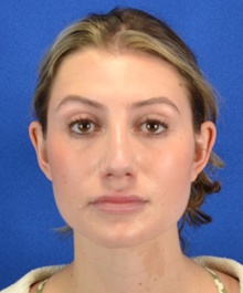 Rhinoplasty After Photo by Alexander Slocum, MD, PhD; Portsmouth, NH - Case 47380