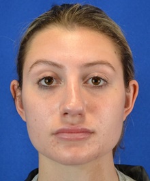 Rhinoplasty Before Photo by Alexander Slocum, MD, PhD; Portsmouth, NH - Case 47380