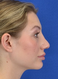 Rhinoplasty After Photo by Alexander Slocum, MD, PhD; Portsmouth, NH - Case 47380