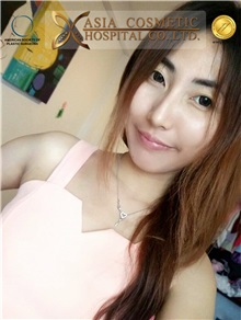 Breast Augmentation Before Photo by Tanongsak Panyawirunroj, MD, FRCST; Mueang, Nonthaburee, BM - Case 30017