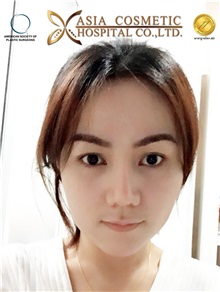 Chin Augmentation After Photo by Tanongsak Panyawirunroj, MD, FRCST; Mueang, Nonthaburee, BM - Case 30019