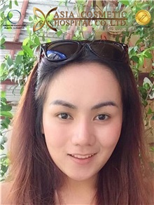 Chin Augmentation Before Photo by Tanongsak Panyawirunroj, MD, FRCST; Mueang, Nonthaburee, BM - Case 30019