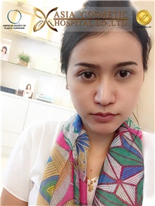 Chin Augmentation Before Photo by Tanongsak Panyawirunroj, MD, FRCST; Mueang, Nonthaburee, BM - Case 30021