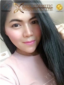 Chin Augmentation After Photo by Tanongsak Panyawirunroj, MD, FRCST; Mueang, Nonthaburee, BM - Case 30022