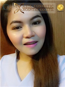 Chin Augmentation Before Photo by Tanongsak Panyawirunroj, MD, FRCST; Mueang, Nonthaburee, BM - Case 30022