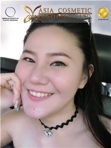 Chin Augmentation After Photo by Tanongsak Panyawirunroj, MD, FRCST; Mueang, Nonthaburee, BM - Case 30023