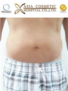 Liposuction After Photo by Tanongsak Panyawirunroj, MD, FRCST; Mueang, Nonthaburee, BM - Case 30024