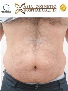Liposuction Before Photo by Tanongsak Panyawirunroj, MD, FRCST; Mueang, Nonthaburee, BM - Case 30024