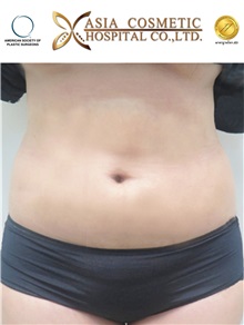 Liposuction After Photo by Tanongsak Panyawirunroj, MD, FRCST; Mueang, Nonthaburee, BM - Case 30025