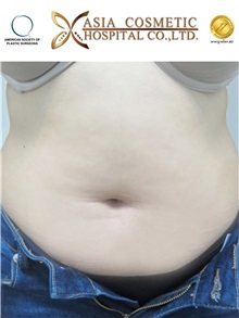 Liposuction Before Photo by Tanongsak Panyawirunroj, MD, FRCST; Mueang, Nonthaburee, BM - Case 30025