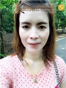 Skull/Facial Bone Reconstruction Before Photo by Tanongsak Panyawirunroj, MD, FRCST; Mueang, Nonthaburee, BM - Case 30032