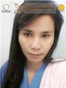 Skull/Facial Bone Reconstruction Before Photo by Tanongsak Panyawirunroj, MD, FRCST; Mueang, Nonthaburee, BM - Case 30034