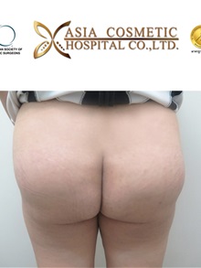 Buttock Implants After Photo by Tanongsak Panyawirunroj, MD, FRCST; Mueang, Nonthaburee, BM - Case 30035