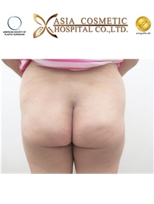 Buttock Implants Before Photo by Tanongsak Panyawirunroj, MD, FRCST; Mueang, Nonthaburee, BM - Case 30035