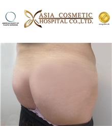 Buttock Implants After Photo by Tanongsak Panyawirunroj, MD, FRCST; Mueang, Nonthaburee, BM - Case 30036