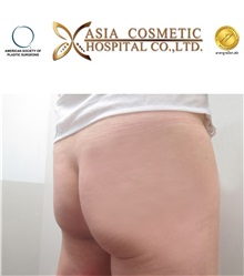 Buttock Implants Before Photo by Tanongsak Panyawirunroj, MD, FRCST; Mueang, Nonthaburee, BM - Case 30036