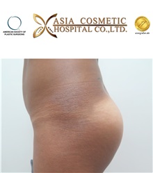 Buttock Implants After Photo by Tanongsak Panyawirunroj, MD, FRCST; Mueang, Nonthaburee, BM - Case 30037