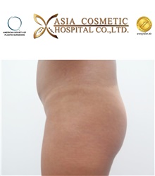 Buttock Implants Before Photo by Tanongsak Panyawirunroj, MD, FRCST; Mueang, Nonthaburee, BM - Case 30037