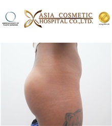Buttock Implants After Photo by Tanongsak Panyawirunroj, MD, FRCST; Mueang, Nonthaburee, BM - Case 30038