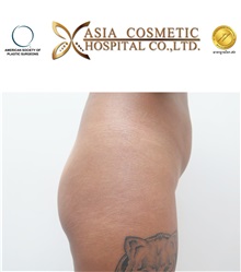 Buttock Implants Before Photo by Tanongsak Panyawirunroj, MD, FRCST; Mueang, Nonthaburee, BM - Case 30038
