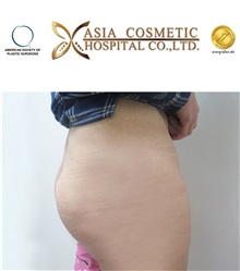 Buttock Implants After Photo by Tanongsak Panyawirunroj, MD, FRCST; Mueang, Nonthaburee, BM - Case 30039