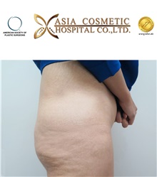 Buttock Implants Before Photo by Tanongsak Panyawirunroj, MD, FRCST; Mueang, Nonthaburee, BM - Case 30039