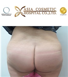 Buttock Implants After Photo by Tanongsak Panyawirunroj, MD, FRCST; Mueang, Nonthaburee, BM - Case 30040