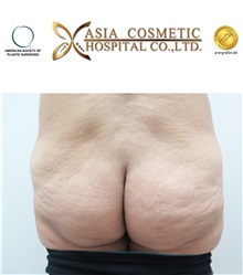 Buttock Implants Before Photo by Tanongsak Panyawirunroj, MD, FRCST; Mueang, Nonthaburee, BM - Case 30040