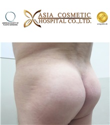 Buttock Implants After Photo by Tanongsak Panyawirunroj, MD, FRCST; Mueang, Nonthaburee, BM - Case 30041