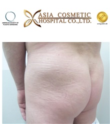 Buttock Implants Before Photo by Tanongsak Panyawirunroj, MD, FRCST; Mueang, Nonthaburee, BM - Case 30041