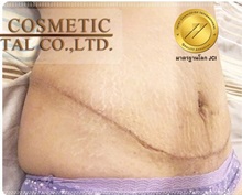 Tummy Tuck After Photo by Tanongsak Panyawirunroj, MD, FRCST; Mueang, Nonthaburee, BM - Case 31780