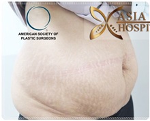 Tummy Tuck Before Photo by Tanongsak Panyawirunroj, MD, FRCST; Mueang, Nonthaburee, BM - Case 31780