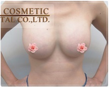 Breast Augmentation After Photo by Tanongsak Panyawirunroj, MD, FRCST; Mueang, Nonthaburee, BM - Case 31784