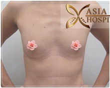 Breast Augmentation Before Photo by Tanongsak Panyawirunroj, MD, FRCST; Mueang, Nonthaburee, BM - Case 31784