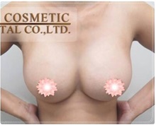 Breast Augmentation After Photo by Tanongsak Panyawirunroj, MD, FRCST; Mueang, Nonthaburee, BM - Case 31785