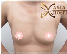 Breast Augmentation Before Photo by Tanongsak Panyawirunroj, MD, FRCST; Mueang, Nonthaburee, BM - Case 31785