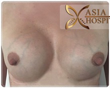 Breast Augmentation Before Photo by Tanongsak Panyawirunroj, MD, FRCST; Mueang, Nonthaburee, BM - Case 31786