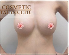 Breast Augmentation After Photo by Tanongsak Panyawirunroj, MD, FRCST; Mueang, Nonthaburee, BM - Case 31787