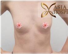 Breast Augmentation Before Photo by Tanongsak Panyawirunroj, MD, FRCST; Mueang, Nonthaburee, BM - Case 31787