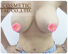 Breast Augmentation After Photo by Tanongsak Panyawirunroj, MD, FRCST; Mueang, Nonthaburee, BM - Case 31789