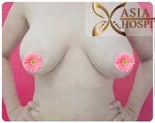 Breast Augmentation Before Photo by Tanongsak Panyawirunroj, MD, FRCST; Mueang, Nonthaburee, BM - Case 31789