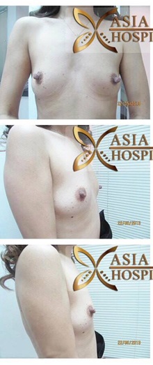 Breast Augmentation Before Photo by Tanongsak Panyawirunroj, MD, FRCST; Mueang, Nonthaburee, BM - Case 31791