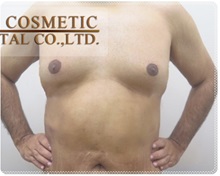 Liposuction After Photo by Tanongsak Panyawirunroj, MD, FRCST; Mueang, Nonthaburee, BM - Case 31798