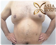 Liposuction Before Photo by Tanongsak Panyawirunroj, MD, FRCST; Mueang, Nonthaburee, BM - Case 31798