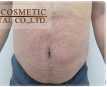 Liposuction After Photo by Tanongsak Panyawirunroj, MD, FRCST; Mueang, Nonthaburee, BM - Case 31799