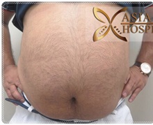 Liposuction Before Photo by Tanongsak Panyawirunroj, MD, FRCST; Mueang, Nonthaburee, BM - Case 31799