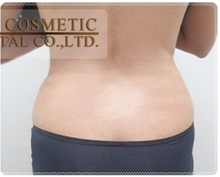 Liposuction After Photo by Tanongsak Panyawirunroj, MD, FRCST; Mueang, Nonthaburee, BM - Case 31801