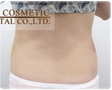 Liposuction After Photo by Tanongsak Panyawirunroj, MD, FRCST; Mueang, Nonthaburee, BM - Case 31802