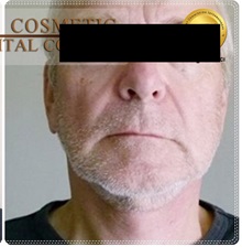 Facelift After Photo by Tanongsak Panyawirunroj, MD, FRCST; Mueang, Nonthaburee, BM - Case 31803